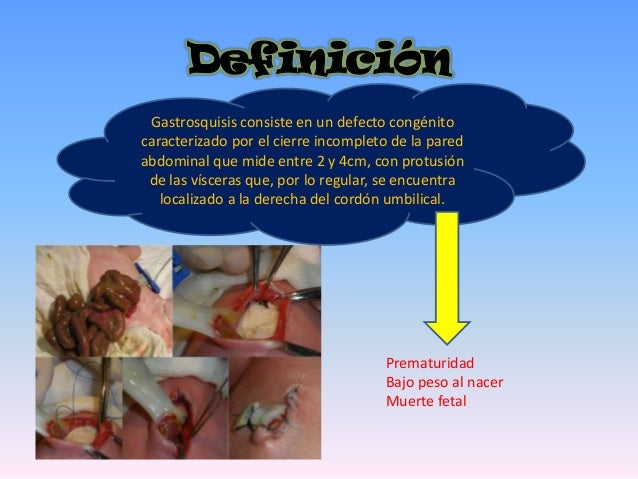 gastrosquisis definicion